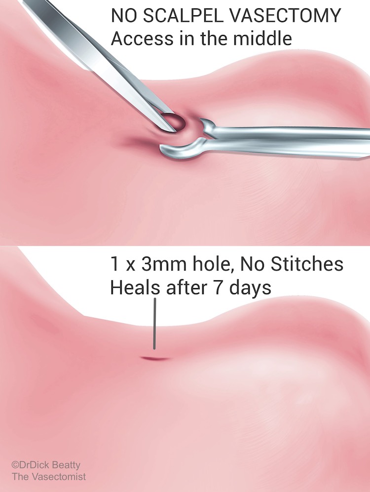 vasectomy stitches