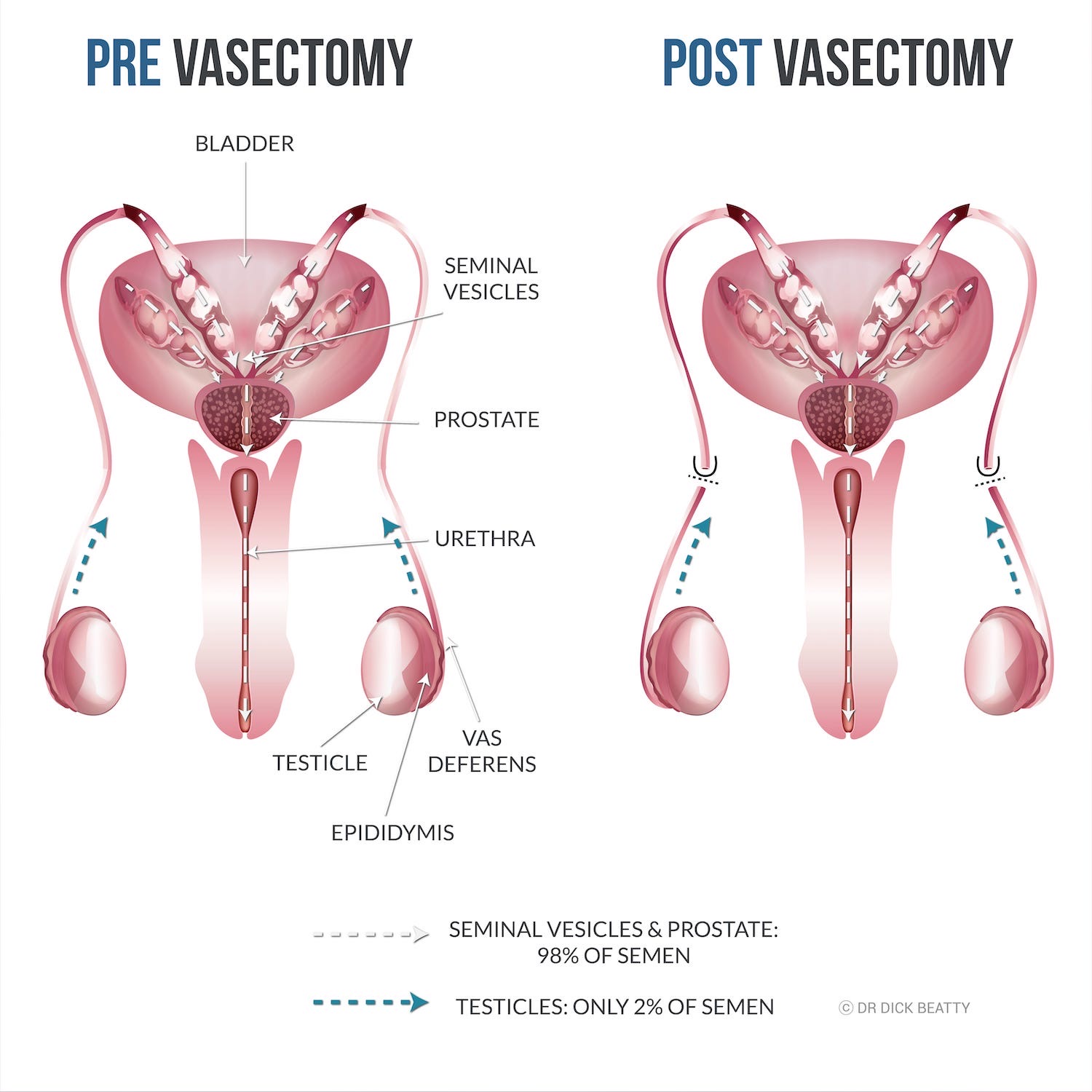 About Vasectomy - What, How, Why, Risks & Myths - in words & figures