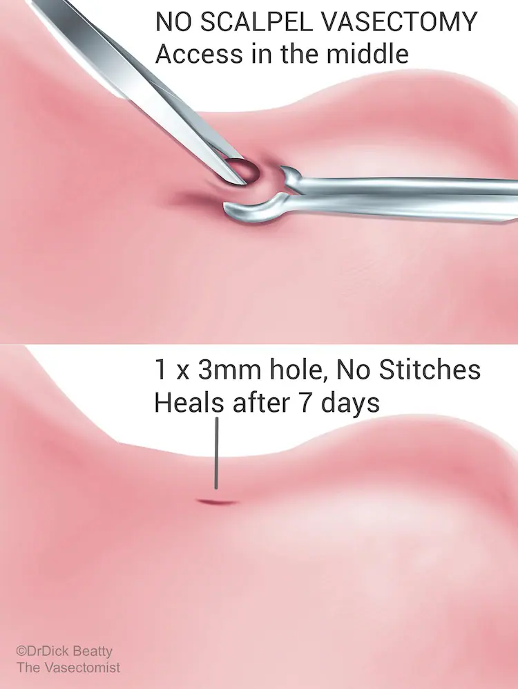 Illustration comparing skin instruments used in open, and no-scalpel vasectomy