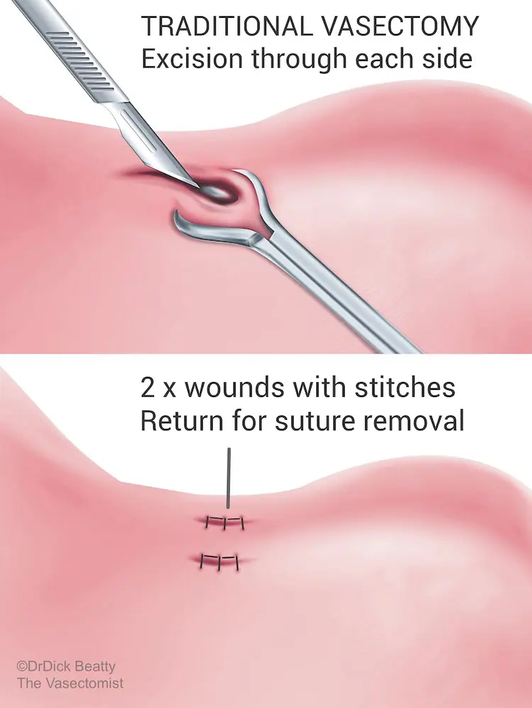 Illustration showing the skin after both an open, and no-scalpel, vasectomy