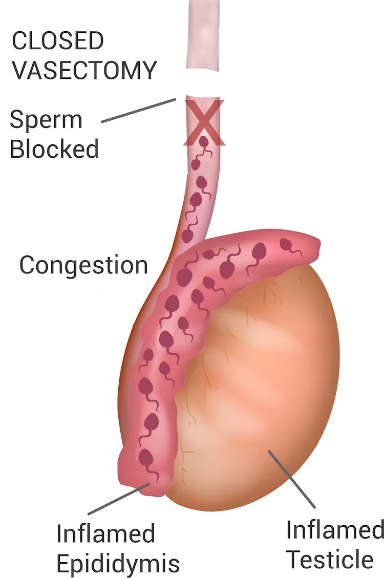 Illustration showing sperm being blocked after a closed vasectomy, causing an inflamed epididymis
