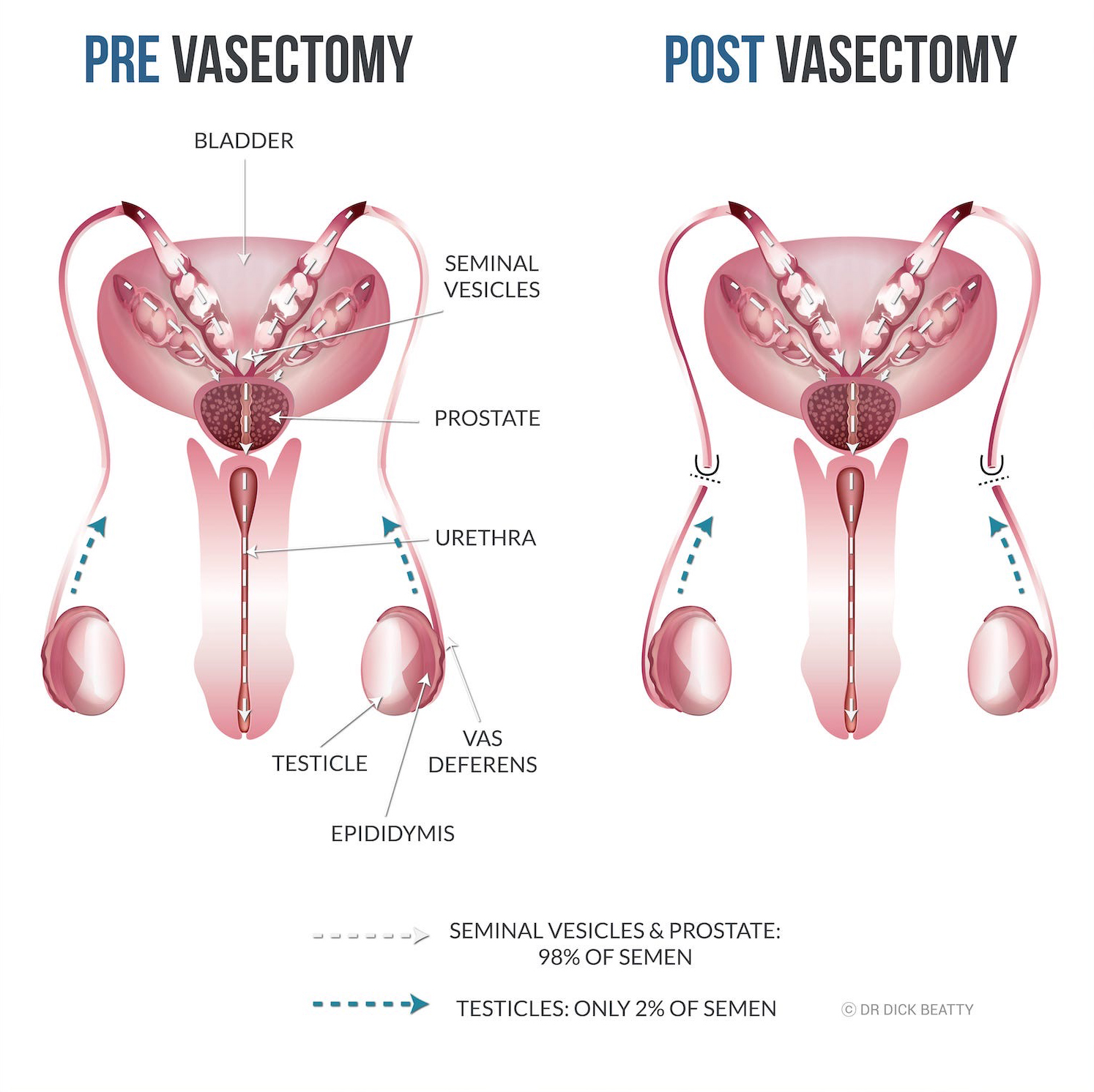Illustration of male genital anatomy before and after a vasectomy